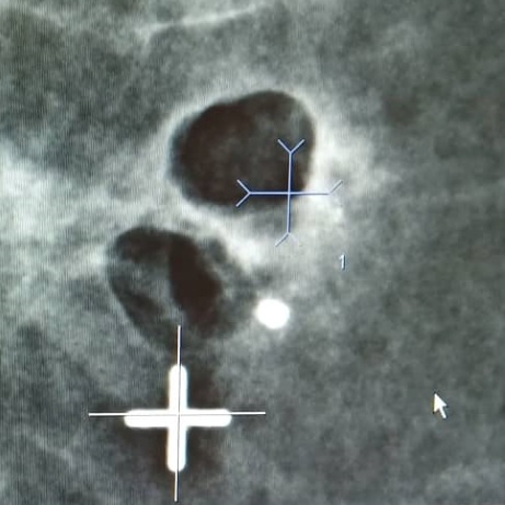 Мамографски образ на рисковото образувание, което е биопсирано с вакуум
